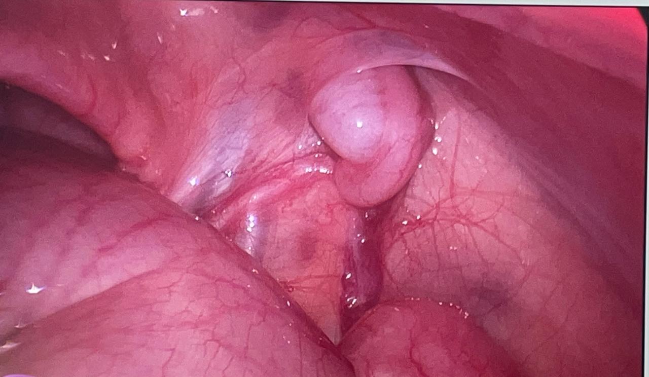 Pediatric Laparoscopic Surgery Image 1