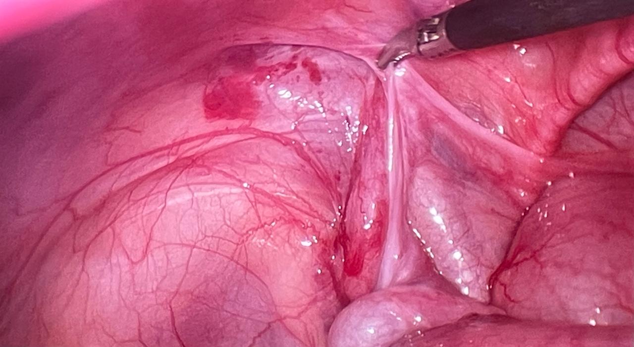 Pediatric Laparoscopic Surgery Image 2