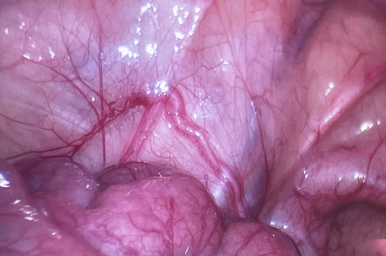 Pediatric Laparoscopic Surgery Image 3
